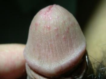 男性急性龟头炎是怎么回事