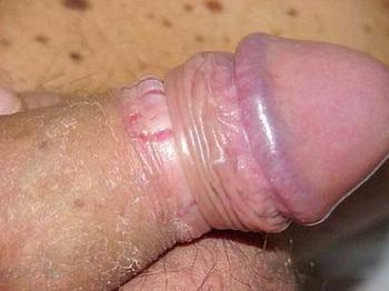 男性预防龟头炎应该注意什么呢