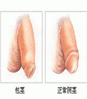 男性包茎的类型有哪些