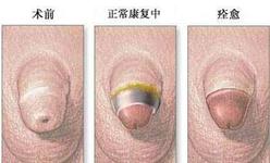 男性包皮过长术后护理怎么做最好