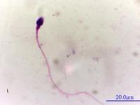 哪些病因是会导致男性死精症发生的