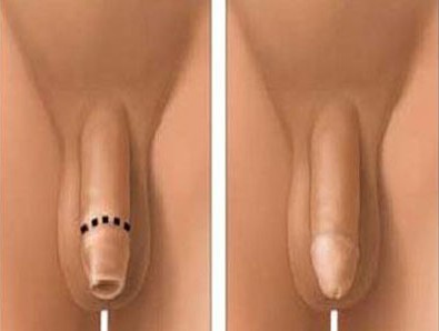 男性做完包皮手术后出现疼痛怎么办