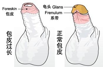 包皮过长会给男性带来哪些危害