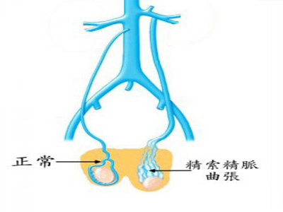 精索静脉曲张的危害