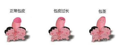 包皮里面有白色异物是怎么回事