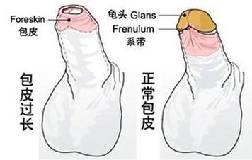 哪些原因会导致男性包皮过长