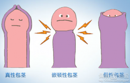 铜川做包皮手术大概多少钱