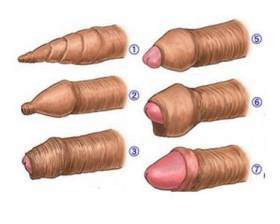 真假性包皮区分