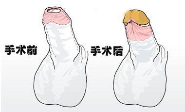 铜川新城医院做包皮手术多钱